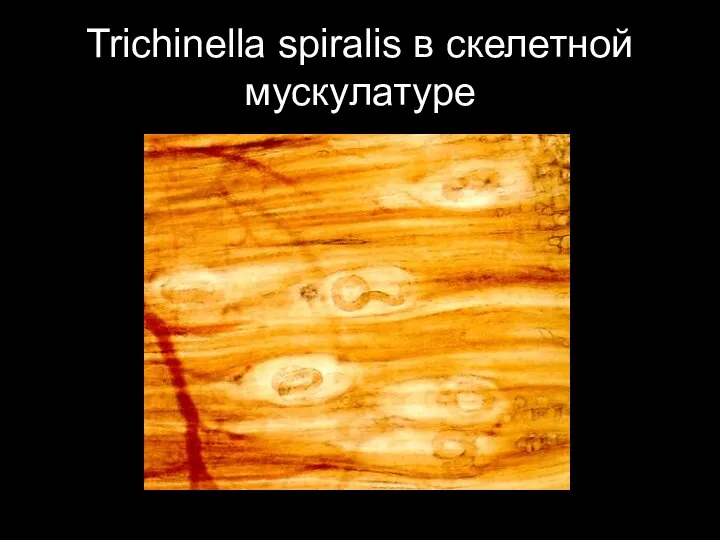 Trichinella spiralis в скелетной мускулатуре