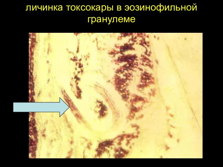 личинка токсокары в эозинофильной гранулеме