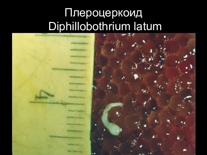 Плероцеркоид Diphillobothrium latum