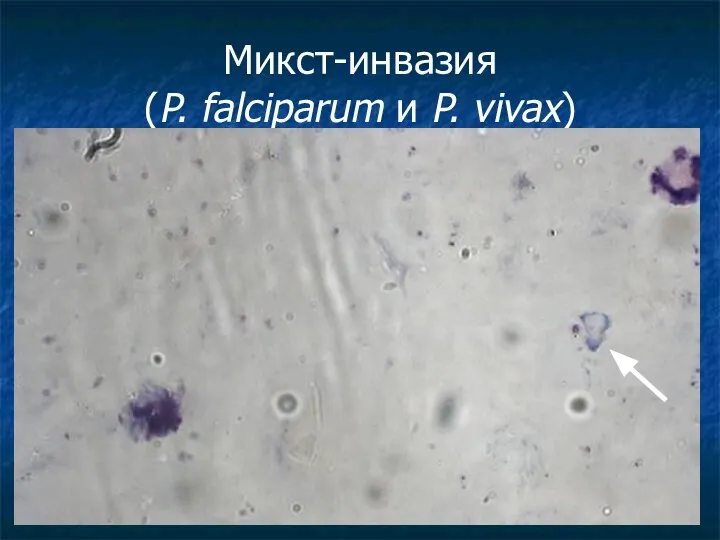 Микст-инвазия (P. falciparum и P. vivax)