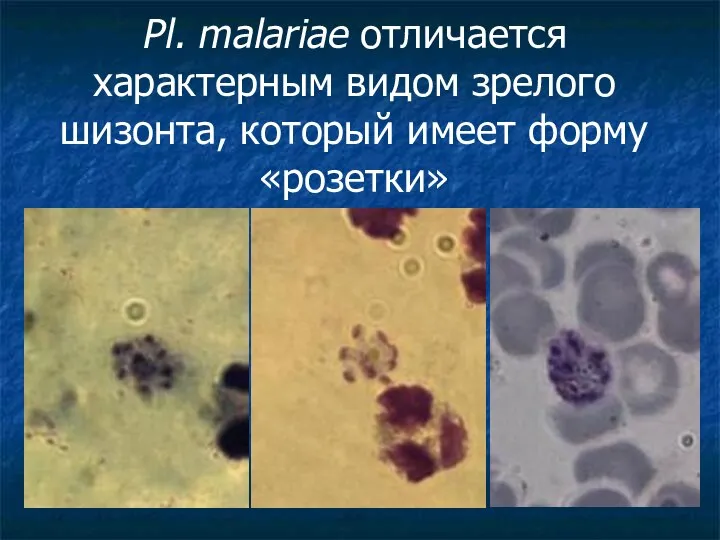 Pl. malariae отличается характерным видом зрелого шизонта, который имеет форму «розетки»