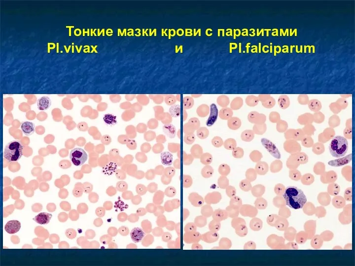 Тонкие мазки крови с паразитами Pl.vivax и Pl.falciparum