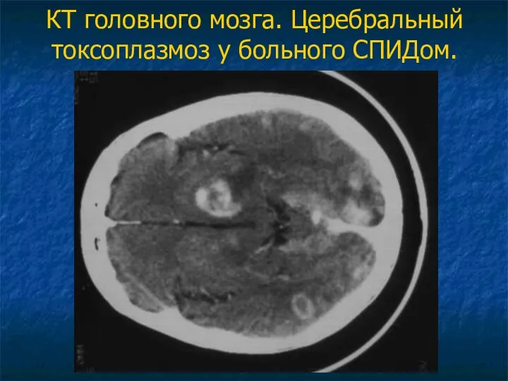 КТ головного мозга. Церебральный токсоплазмоз у больного СПИДом.