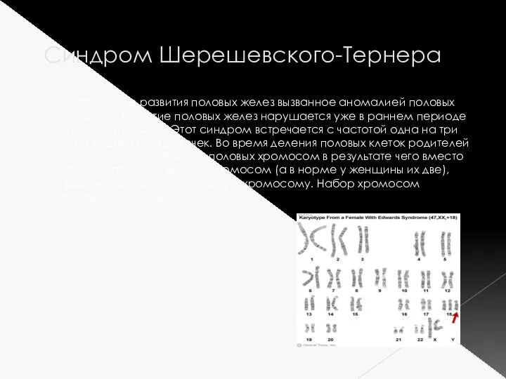 Синдром Шерешевского-Тернера - это нарушение развития половых желез вызванное аномалией половых