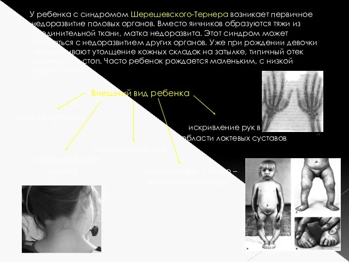 У ребенка с синдромом Шерешевского-Тернера возникает первичное недоразвитие половых органов. Вместо