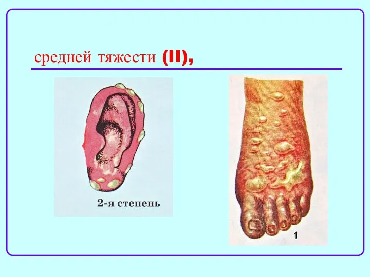 средней тяжести (II),