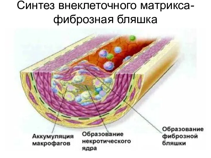 Синтез внеклеточного матрикса-фиброзная бляшка