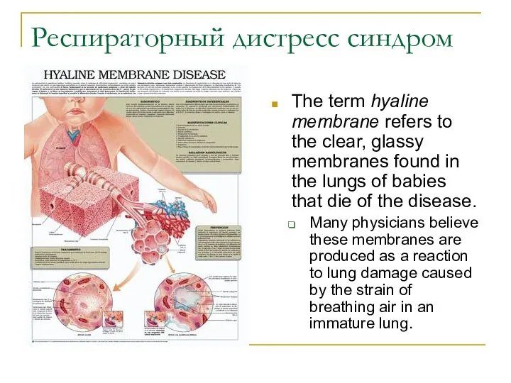 Респираторный дистресс синдром The term hyaline membrane refers to the clear,
