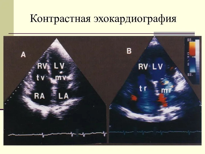 Контрастная эхокардиография