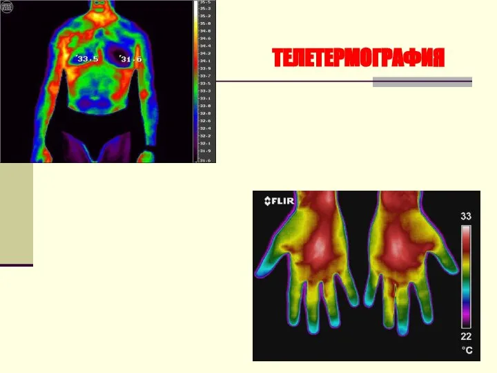 ТЕЛЕТЕРМОГРАФИЯ