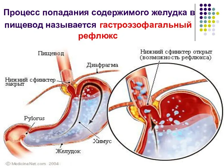 Процесс попадания содержимого желудка в пищевод называется гастроэзофагальный рефлюкс