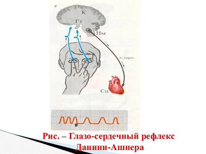 Рис. – Глазо-сердечный рефлекс Данини-Ашнера