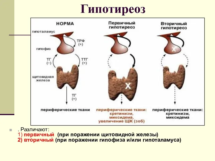 Гипотиреоз . Различают: 1) первичный (при поражении щитовидной железы) 2) вторичный (при поражении гипофиза и/или гипоталамуса)