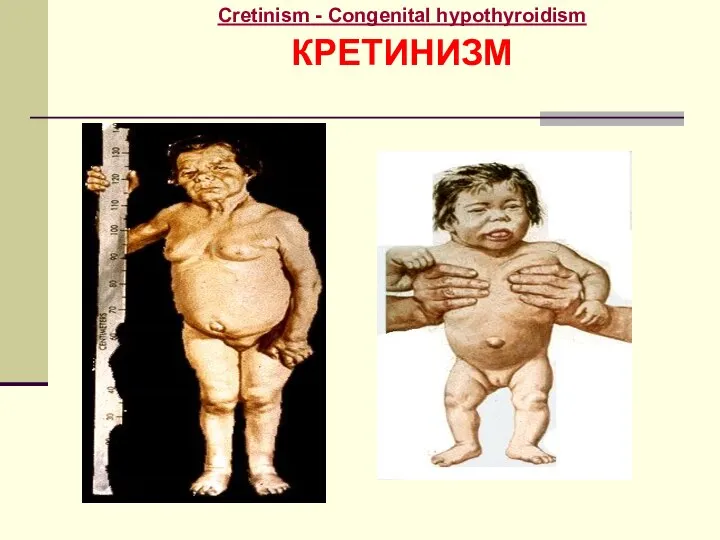 Cretinism - Congenital hypothyroidism КРЕТИНИЗМ