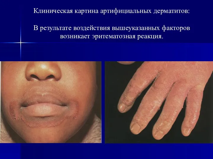 Клиническая картина артифициальных дерматитов: В результате воздействия вышеуказанных факторов возникает эритематозная реакция.