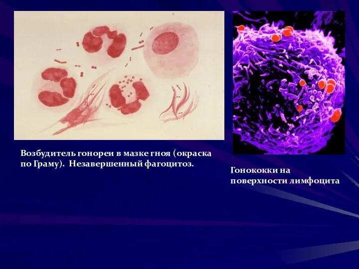 Гонококки на поверхности лимфоцита Возбудитель гонореи в мазке гноя (окраска по Граму). Незавершенный фагоцитоз.