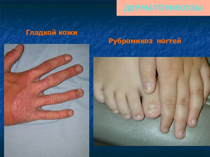 ДЕРМАТОМИКОЗЫ Гладкой кожи Рубромикоз ногтей