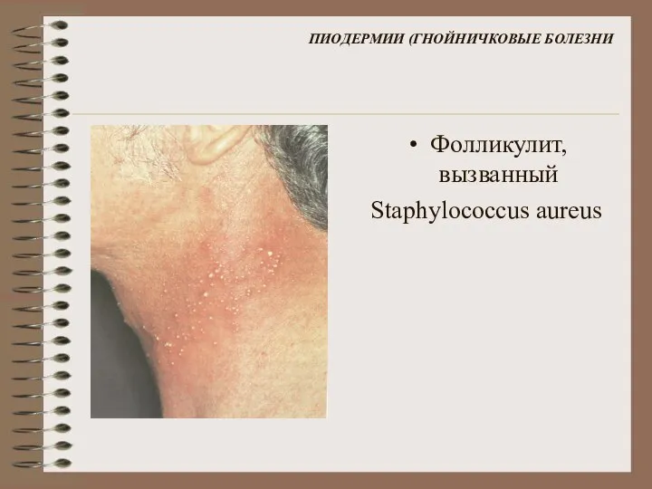 ПИОДЕРМИИ (ГНОЙНИЧКОВЫЕ БОЛЕЗНИ Фолликулит, вызванный Staphylococcus aureus