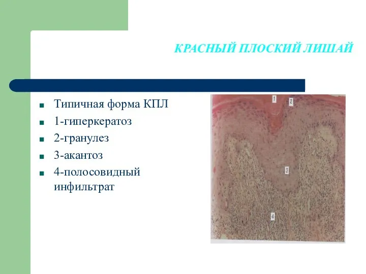 КРАСНЫЙ ПЛОСКИЙ ЛИШАЙ Типичная форма КПЛ 1-гиперкератоз 2-гранулез 3-акантоз 4-полосовидный инфильтрат