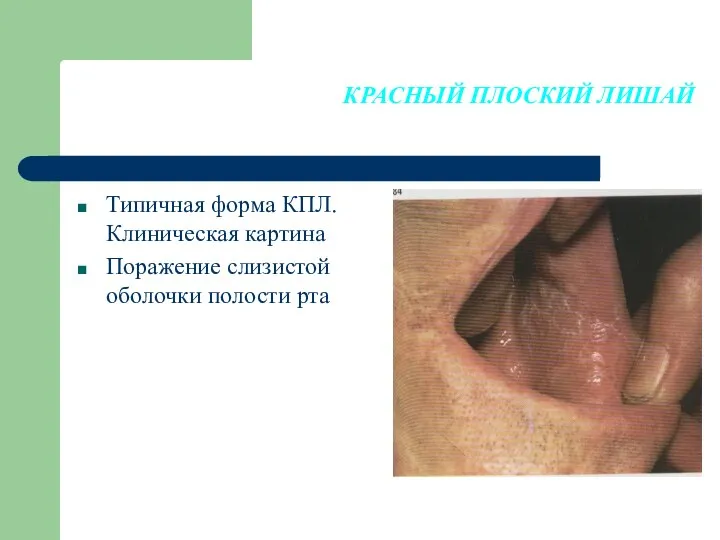 КРАСНЫЙ ПЛОСКИЙ ЛИШАЙ Типичная форма КПЛ. Клиническая картина Поражение слизистой оболочки полости рта