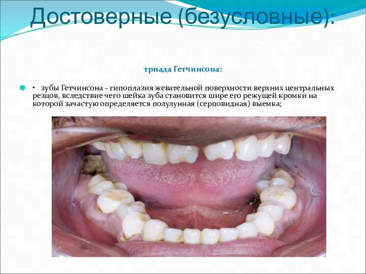 Достоверные (безусловные): триада Гетчинсона: • зубы Гетчинсона - гипоплазия жевательной поверхности