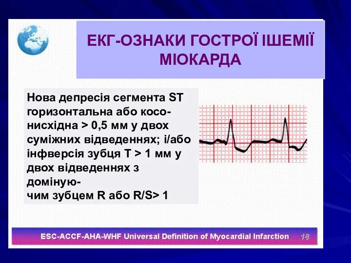 ЕКГ-ОЗНАКИ ГОСТРОЇ ІШЕМІЇ МІОКАРДА Нова депресія сегмента ST горизонтальна або косо-