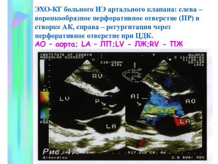 ЭХО-КГ больного ИЭ артального клапана: слева – воронкообразное перфоративное отверстие (ПР)