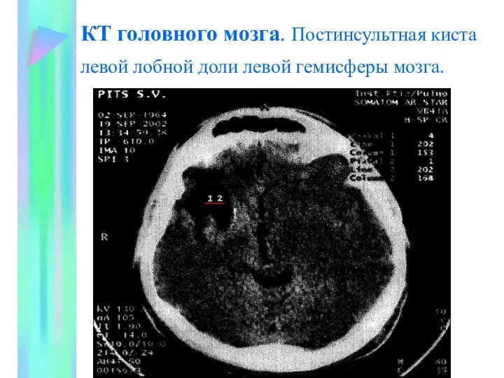 КТ головного мозга. Постинсультная киста левой лобной доли левой гемисферы мозга.