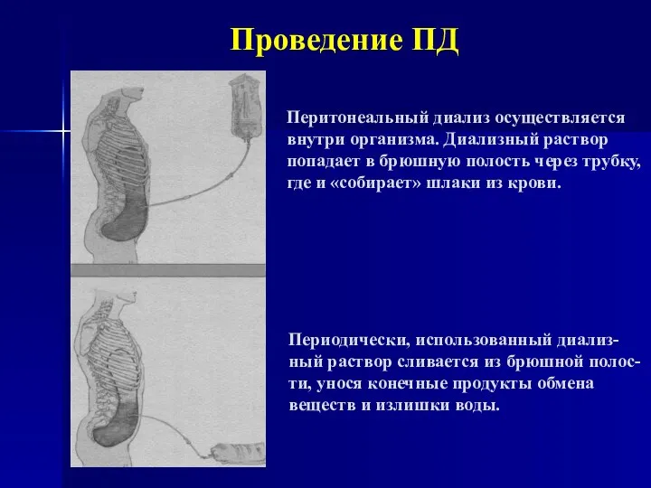 Проведение ПД Перитонеальный диализ осуществляется внутри организма. Диализный раствор попадает в