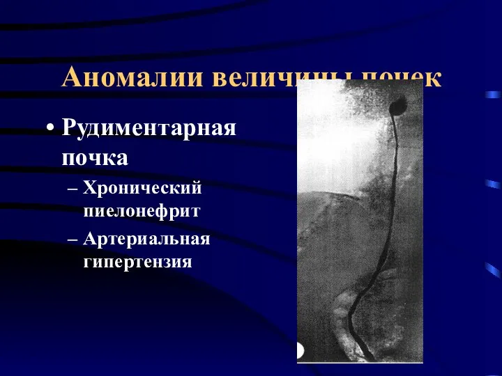 Аномалии величины почек Рудиментарная почка Хронический пиелонефрит Артериальная гипертензия