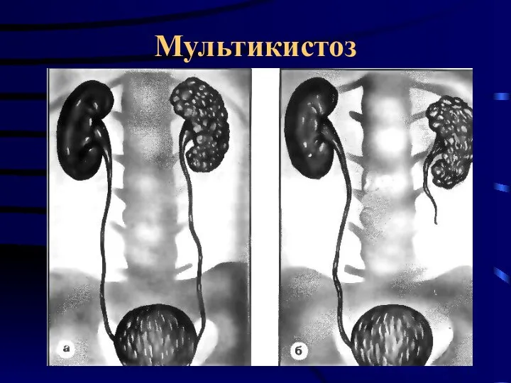 Мультикистоз