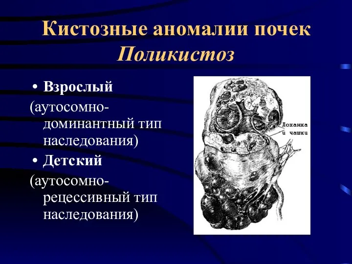 Кистозные аномалии почек Поликистоз Взрослый (аутосомно-доминантный тип наследования) Детский (аутосомно-рецессивный тип наследования)