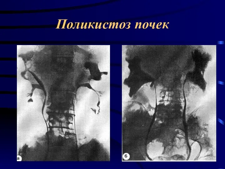 Поликистоз почек