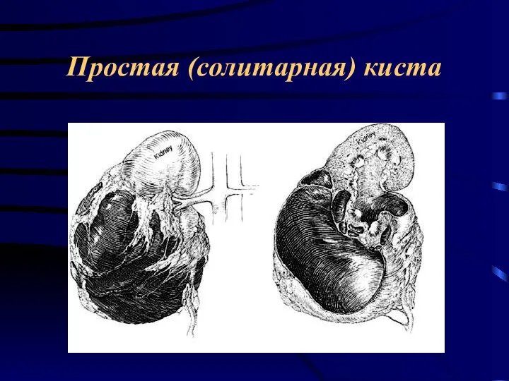 Простая (солитарная) киста