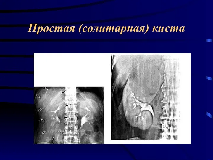 Простая (солитарная) киста