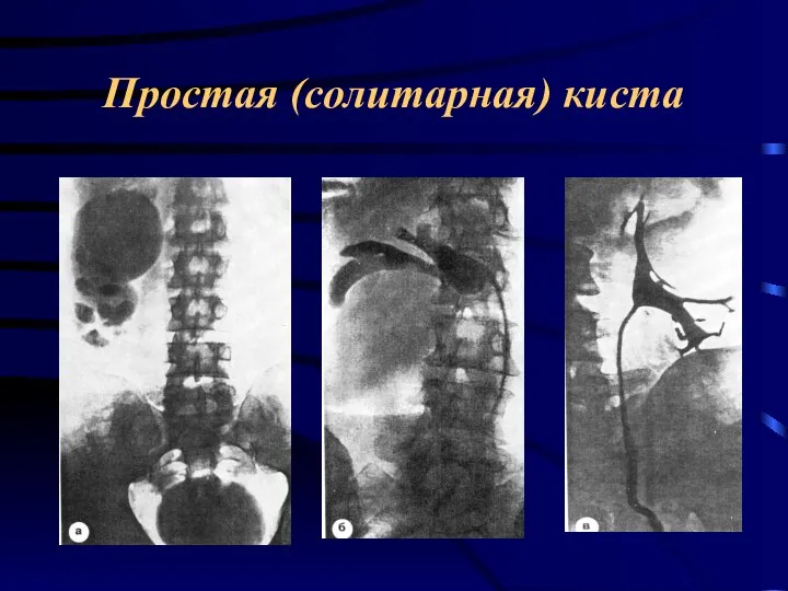 Простая (солитарная) киста