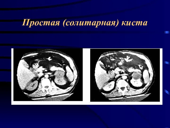 Простая (солитарная) киста