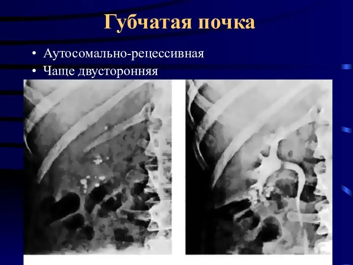 Губчатая почка Аутосомально-рецессивная Чаще двусторонняя