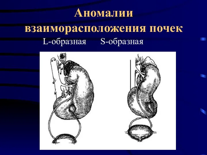 Аномалии взаиморасположения почек L-образная S-образная