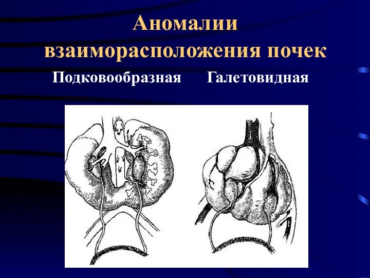 Аномалии взаиморасположения почек Подковообразная Галетовидная