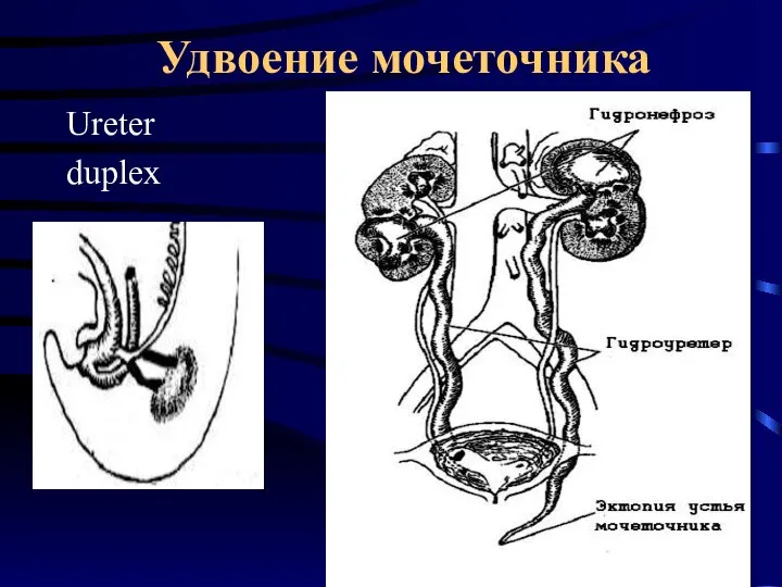 Удвоение мочеточника Ureter duplex