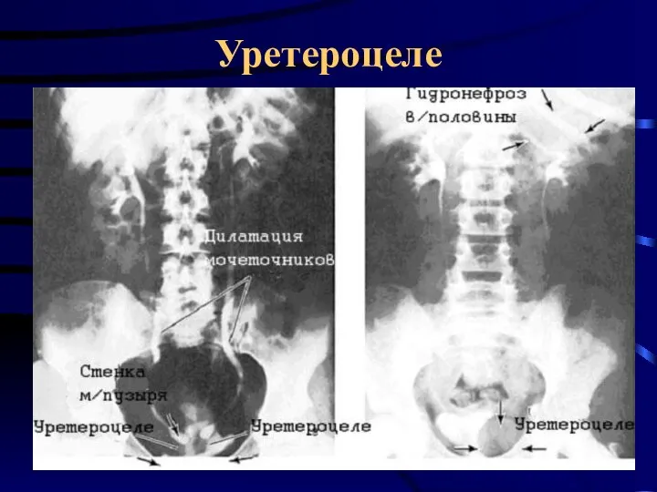 Уретероцеле