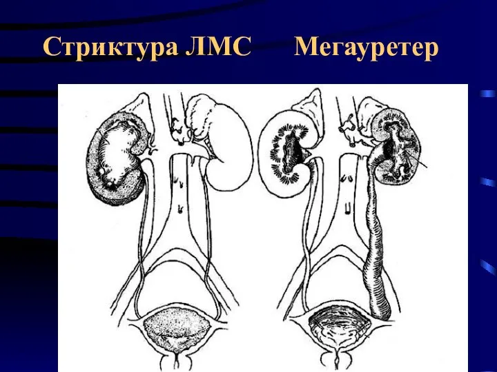 Стриктура ЛМС Мегауретер