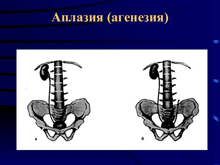 Аплазия (агенезия)