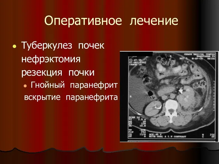 Оперативное лечение Туберкулез почек нефрэктомия резекция почки Гнойный паранефрит вскрытие паранефрита