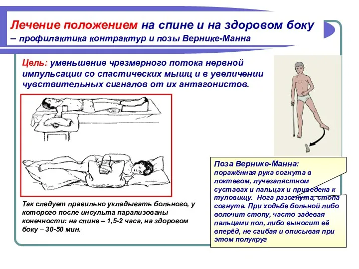 Так следует правильно укладывать больного, у которого после инсульта парализованы конечности: