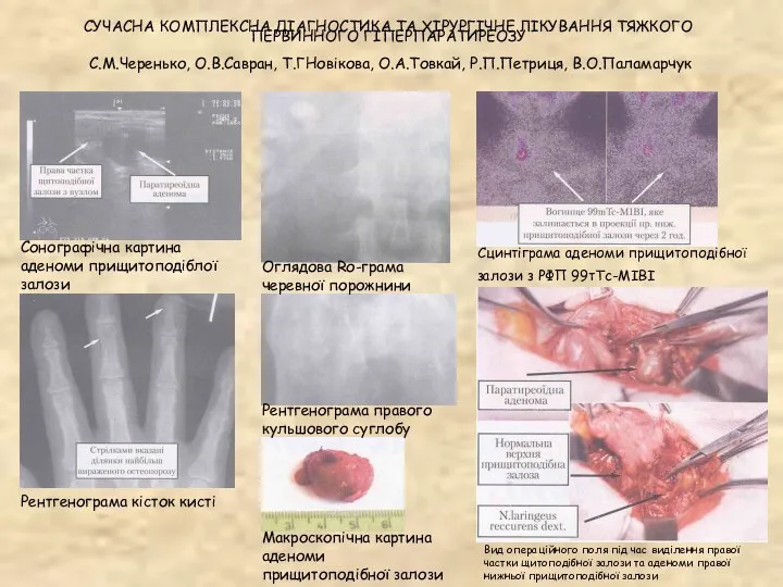 СУЧАСНА КОМПЛЕКСНА ДІАГНОСТИКА ТА ХІРУРГІЧНЕ ЛІКУВАННЯ ТЯЖКОГО ПЕРВИННОГО ГІПЕРПАРАТИРЕОЗУ С.М.Черенько, О.В.Савран,