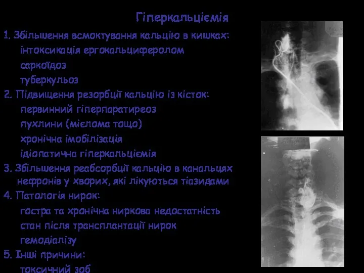 Гіперкальціємія 1. Збільшення всмоктування кальцію в кишках: інтоксикація ергокальциферолом саркоїдоз туберкульоз