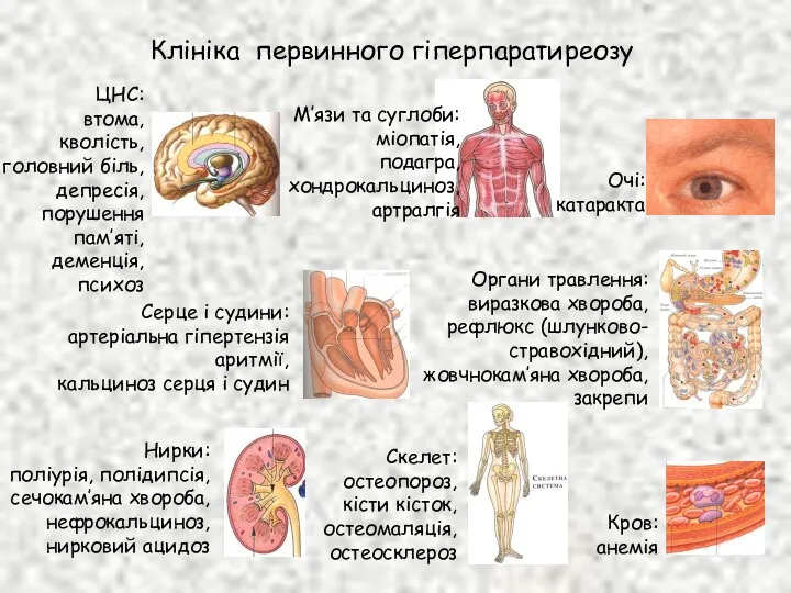 Клініка первинного гіперпаратиреозу ЦНС: втома, кволість, головний біль, депресія, порушення пам’яті,