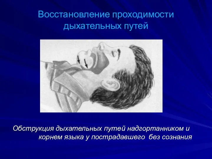 Восстановление проходимости дыхательных путей Обструкция дыхательных путей надгортанником и корнем языка у пострадавшего без сознания